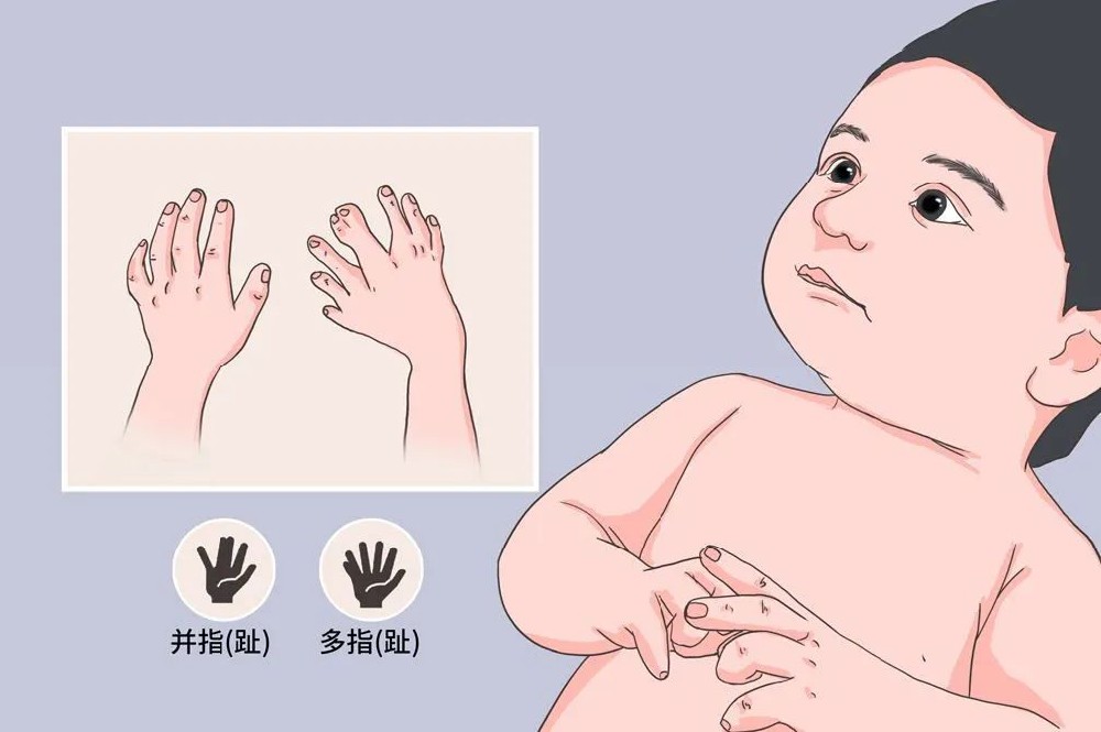 关爱儿童健康——多指、并指（趾）畸形什么时候手术最佳