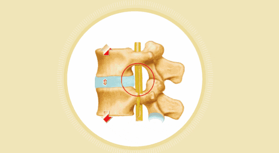 射频消融术——“一针”治疗椎间盘突出症